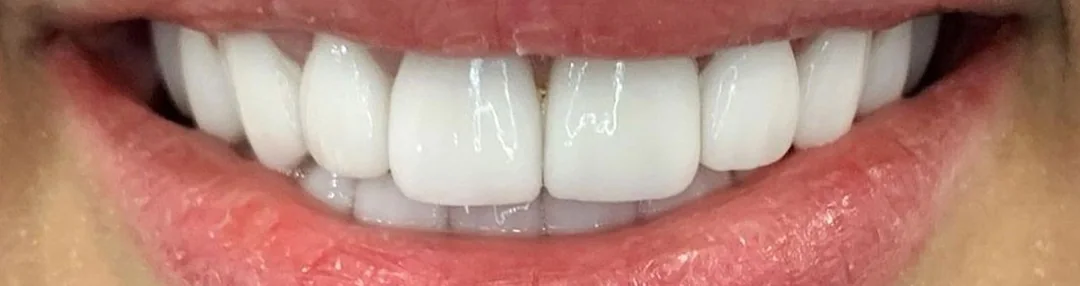 După: Fațete dentare