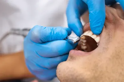 Instrument dentar folosit pentru îngrijirea unui dinte.