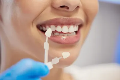 Compararea culorii dinților cu o cheie de culori dentare.