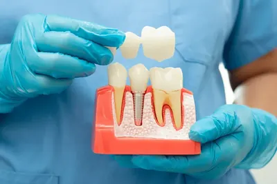 Model dentar cu implant și o punte ridicată deasupra dinților.